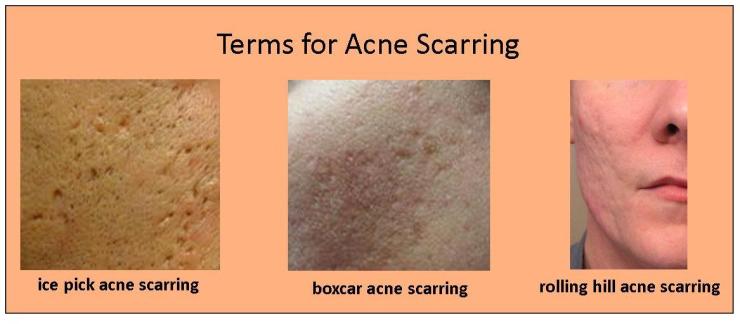 acne-scarring-terms1