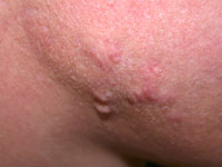 acne-scar7-s