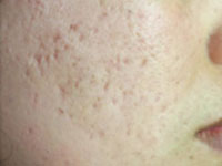 acne-scarring-2-s